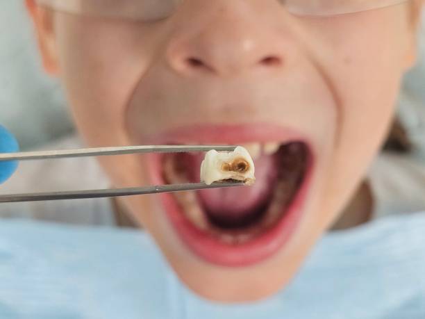 Best Emergency Tooth Extraction in Yreka, CA